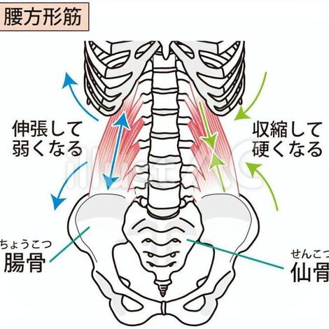 腰方形筋