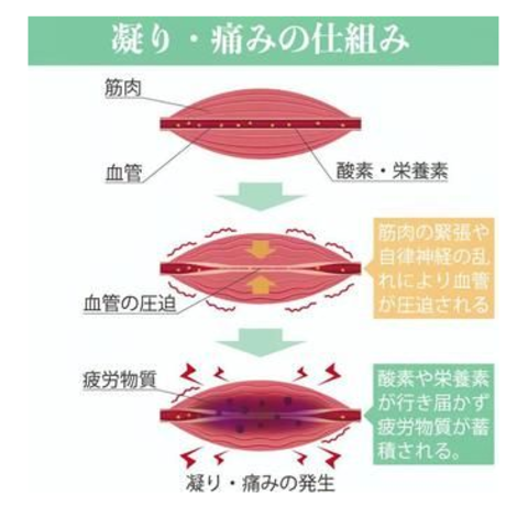 肩こりイラスト”